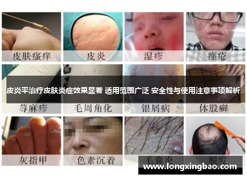 皮炎平治疗皮肤炎症效果显著 适用范围广泛 安全性与使用注意事项解析